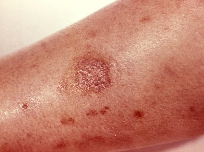 brown recluse spider bite