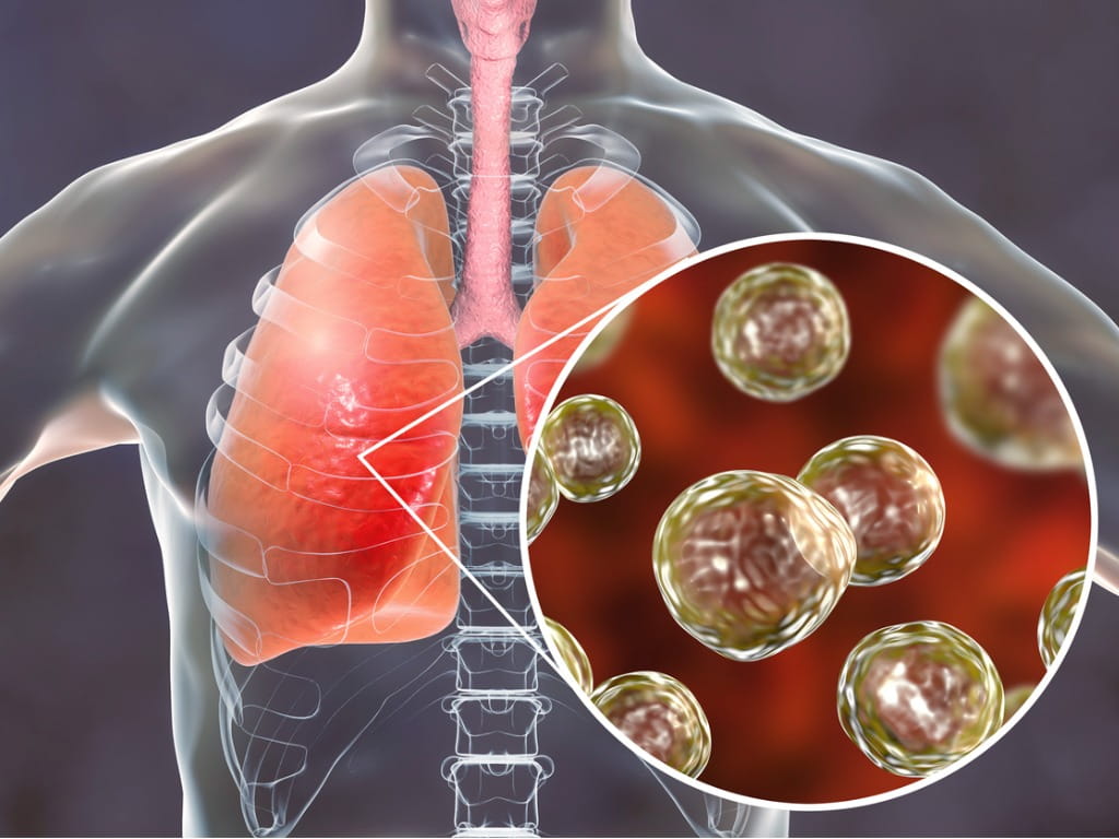 blastomycosis in lungs