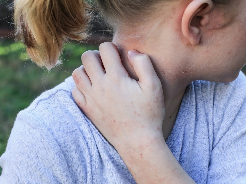 crotamiton young girl scratches scabies infestation on neck