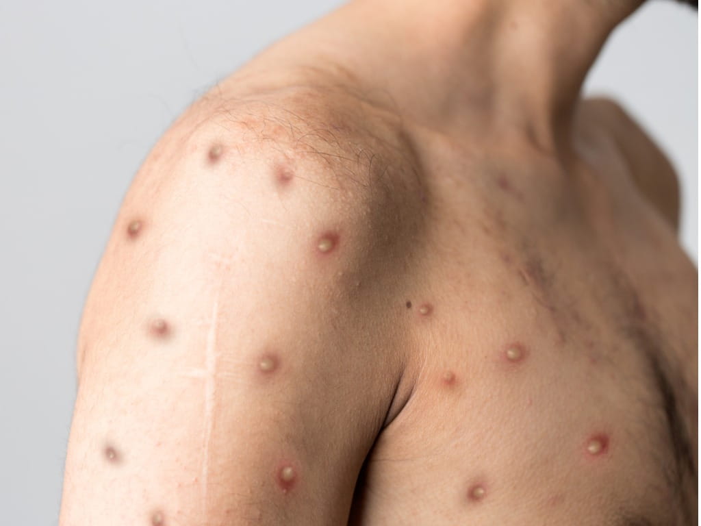 monkeypox rash on chest