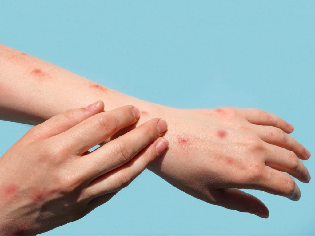 monkeypox rash on hands