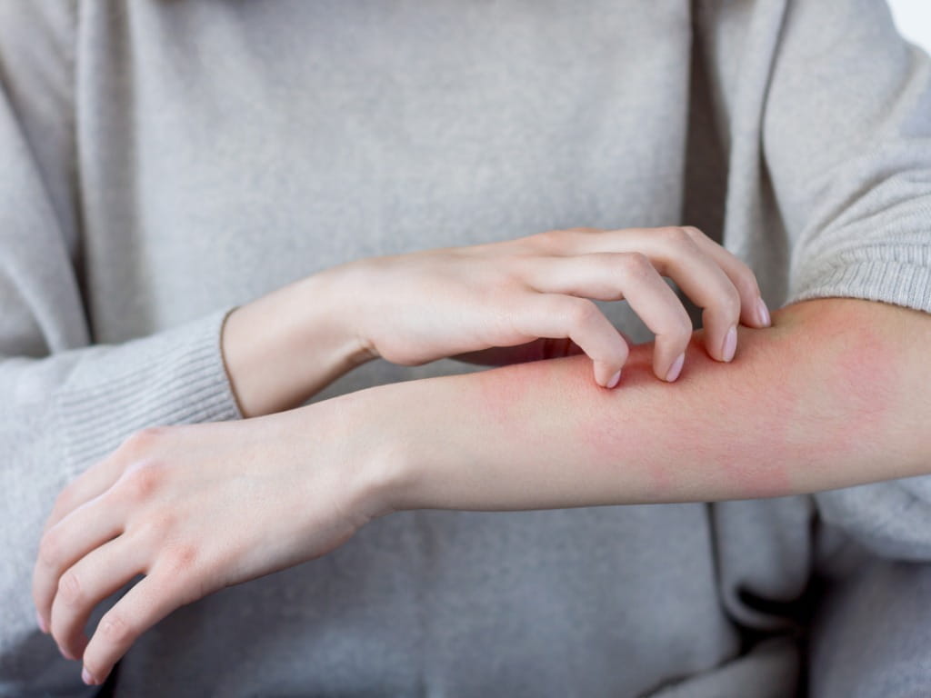 woman scratching a rash on her arm