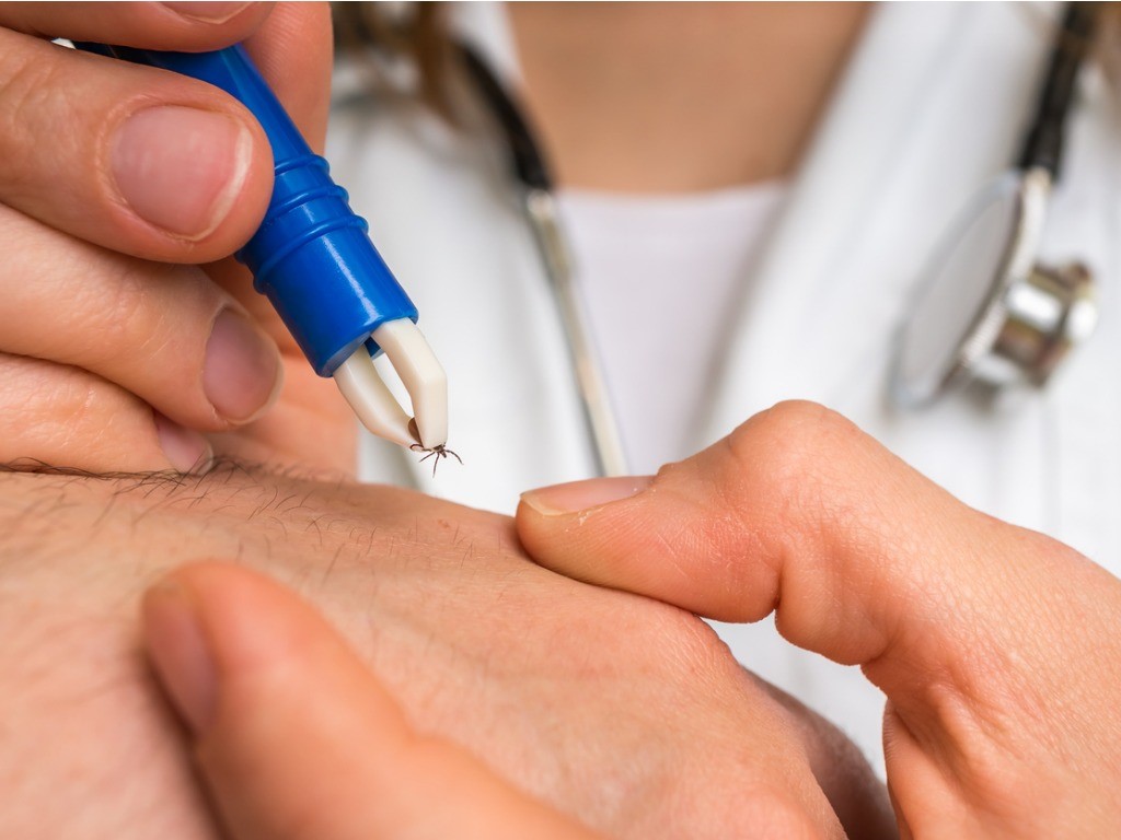 ticks doctor removing tick with tweezers